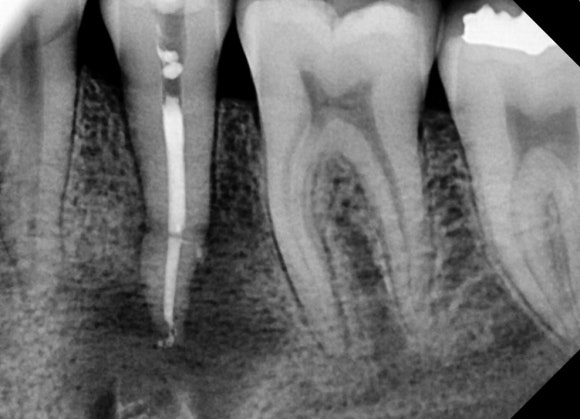 [치외치신경치료] 뿌리 끝 염증이 커서 발치해야된대요! 치아 머리에 볼~록! 알고보면 무서운 작은 혹 (서울재생치과) 관련 이미지 16