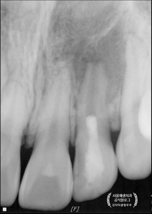 [재생근관치료] 이가 난지 얼마 안 됐는데 신경이 죽었대요...(소아 치아 외상, 치수 괴사, 미성숙 영구치, 신경재생술, REP, 치료기간, MTA 신경치료, 내원횟수) 관련 이미지 15