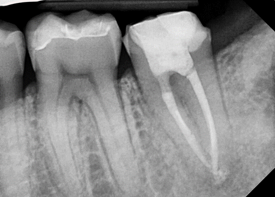 [신경치료] 아래 어금니를 신경치료 할 때 치료할 때 알아야 할 것 (C형근관,고난이도치료) 관련 이미지 9
