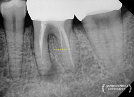 [재신경치료] 예전에 신경치료 받은 치아가 갑자기 붓고 아파요! (현미경을 통해 정확하고 섬세하게 재신경치료 하기) 관련 이미지 27