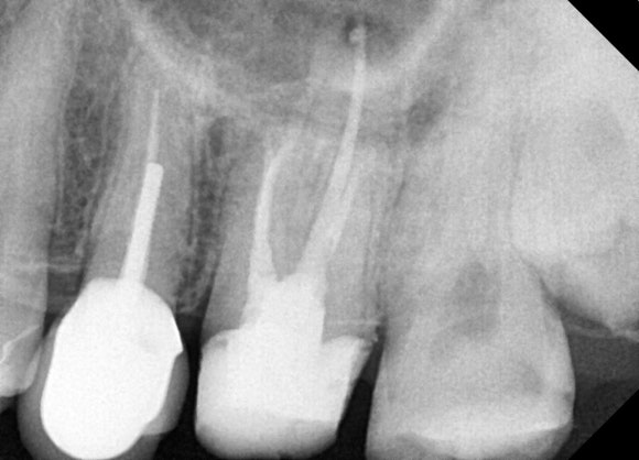 [치아살리기] 부러진 치아를 빼고 임플란트해야 한대요. 관련 이미지 6