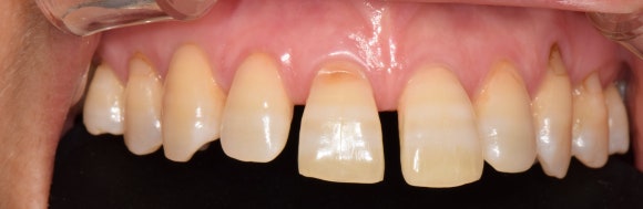 [치료사례] 벌어진 앞니 사이 공간...반드시 라미네이트와 크라운을 해야하나요? 레진으로 간단하고 예쁘게 성형하기 관련 이미지 3