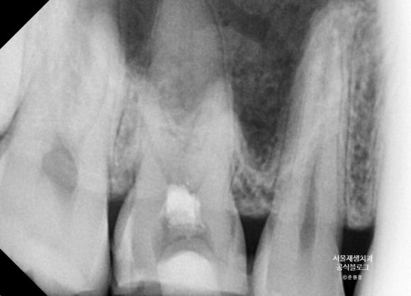 윗 어금니 신경치료 후에 코피가 나요 (신경치료 후 주의사항, 상악동, 신촌 서울재생치과, 신촌 신경치료 맛집, 현미경 신경치료) 관련 이미지 5