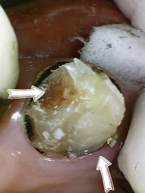 크라운 다음은 임플란트인가요...? (크라운 밑으로 생긴 충치, 크라운 다음엔 어떤 치료를...?, 자연치아 살리는 치과, 서울재생치과) 관련 이미지 6