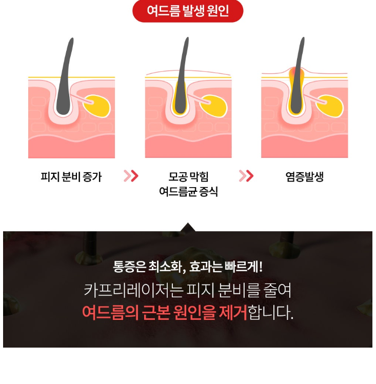 동대문역사문화공원역피부과 여드름, 근본적인 원인 제거가 중요! 관련 이미지 5