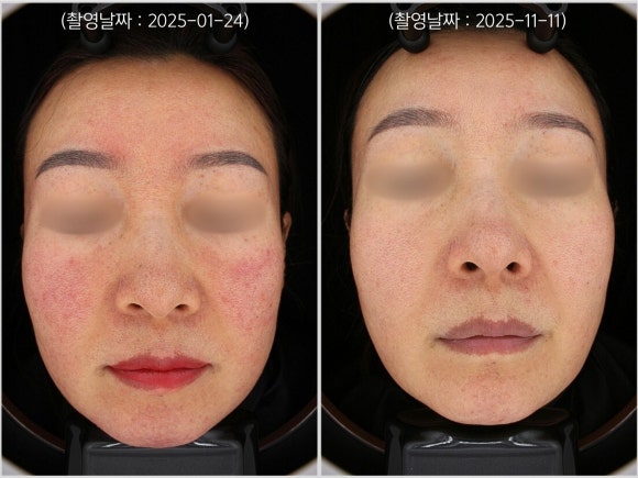 영등포 레이저토닝으로 홍조 치료한 사례 관련 이미지 1