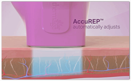 영등포구청역 피부과 진료, 울쎄라피프라임 써마지FLX 뭐가 좋아진 걸까? 관련 이미지 7