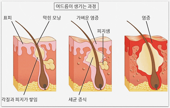 영등포여드름피부과 진료, 약 먹기 싫고 치료 통증 두렵다면? 관련 이미지 2