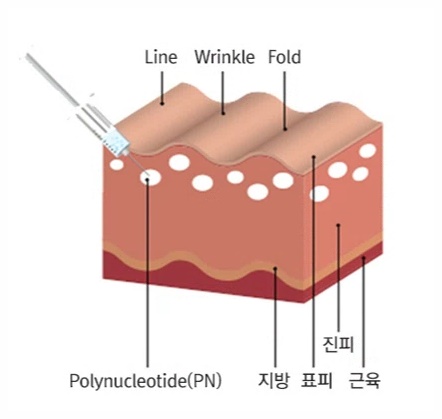 영등포 리쥬란 힐러 피부 재생 효과 보려면? 관련 이미지 3
