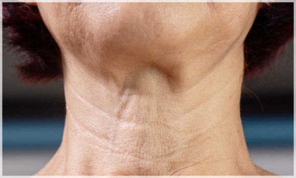 Yeongdeungpo Onda Lifting: Is it Effective for a Double Chin and Under-Chin Fat? image 2