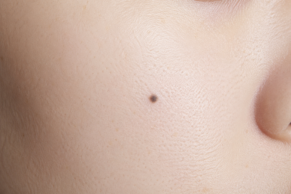 영등포점제거, 재발하는 진짜 이유 알려드립니다. 관련 이미지 1