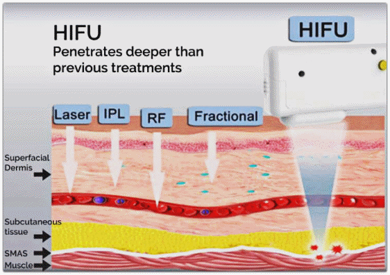 영등포슈링크 원리 뜻 정확히 알고 받으셔야 합니다 관련 이미지 2