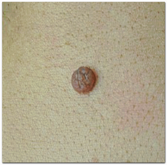 영등포 피부과 점빼기, 점 재발이 걱정된다면? 관련 이미지 8