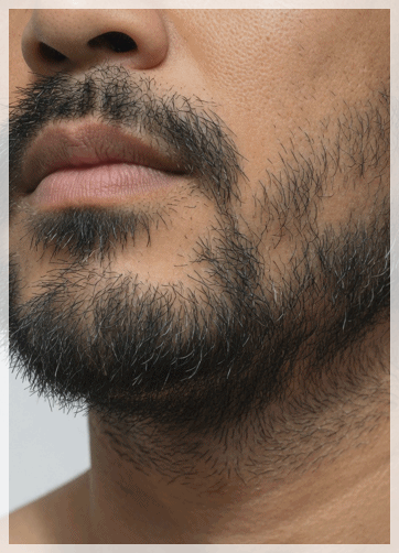 Yeongdeungpo GentleMax Pro Plus: Why Is Satisfaction with Hair Removal Different? image 6