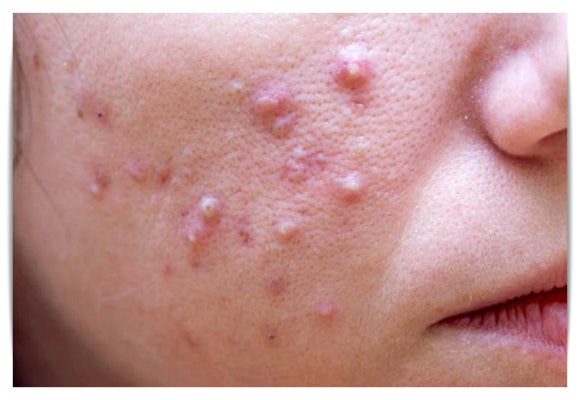 영등포편평사마귀 원인 특징 제거법 확인하세요 관련 이미지 5