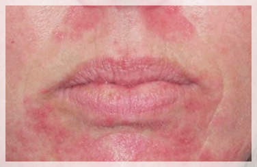 Mullae Dermatology Clinic: Differences in Skin Concerns You Should Know Before Your Appointment image 6