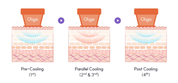 영등포올리지오 가성비 리프팅? 탄력, 볼륨, 라인 3가지 효과 관련 이미지 4