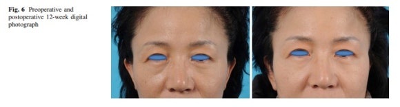 눈밑처짐 리프팅 아이울쎄라로 가능할까? 관련 이미지 6