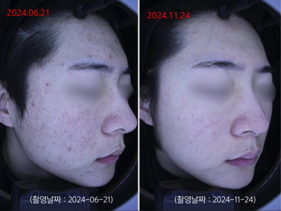 영등포 여드름 치료 사례 군대 전역 후 악화된 트러블 개선 관련 이미지 5