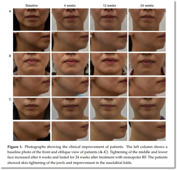 올리지오 유지기간 얼마나 오래가는지 궁금하다면? 관련 이미지 7