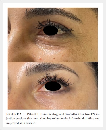 아이리쥬란 다크서클 눈가주름 개선 효과는? 관련 이미지 4