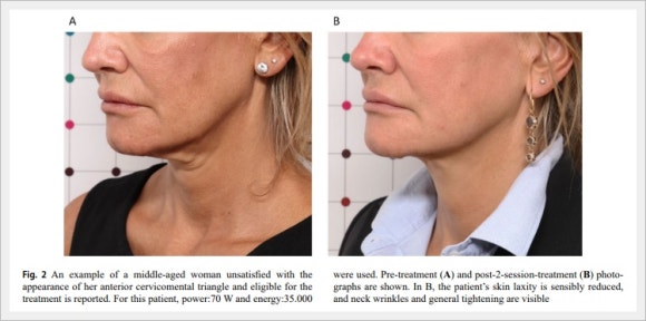 Yeongdeungpo Onda Lifting: Can It Improve a Sagging Jawline? <A Review of the Research> image 8