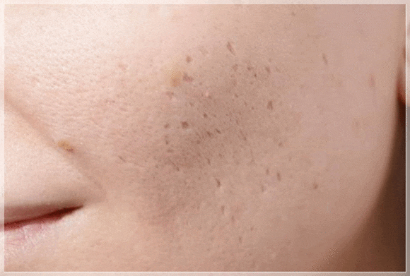 Yeongdeungpo Acne Scars: Which Treatment Does My Case Need? image 2