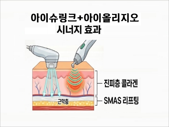 아이슈링크 vs. 아이올리지오 뭐가 좋을까 관련 이미지 7
