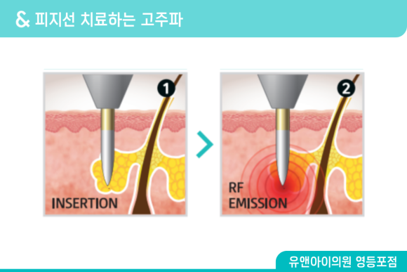 Yeongdeungpo Acne Treatment: What Should You Look at First When Acne Keeps Coming Back? image 3