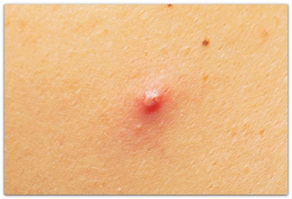 영등포여드름치료, 시술로 효과 보려면? 관련 이미지 3