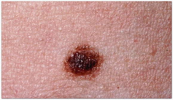 영등포 피부과 점빼기, 점 재발이 걱정된다면? 관련 이미지 9