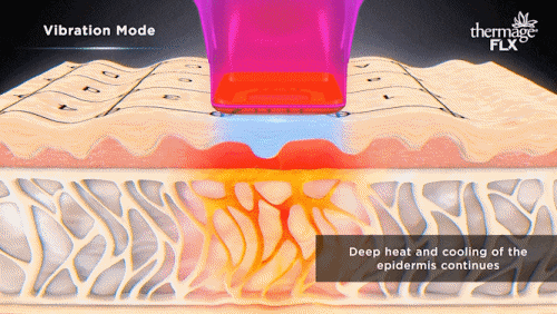 영등포구청역 피부과 진료, 울쎄라피프라임 써마지FLX 뭐가 좋아진 걸까? 관련 이미지 6