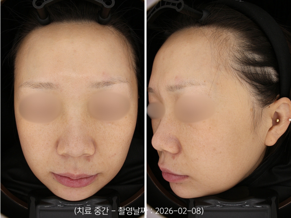 Yeongdeungpo Laser Toning: How Is Melasma That Developed After Childbirth Treated? image 6