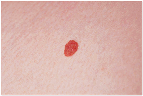 영등포 피부과 점빼기, 점 재발이 걱정된다면? 관련 이미지 2