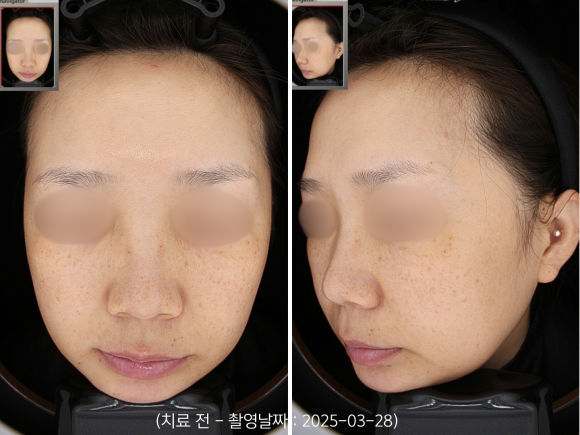 Yeongdeungpo Laser Toning: How Is Melasma That Developed After Childbirth Treated? image 1