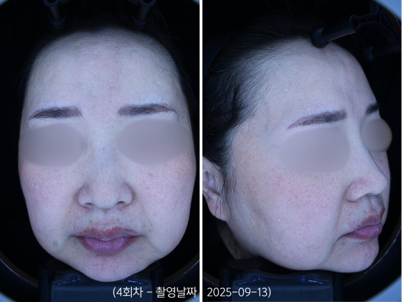 영등포 홍조치료, 안면홍조 레이저 받으면 붉은기가 좋아지나요? 관련 이미지 5