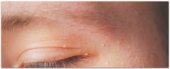 영등포비립종 한관종 편평사마귀 차이, 어린이도 제거 치료될까? 관련 이미지 3