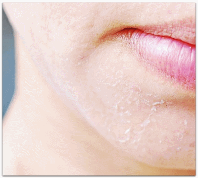 레스틸렌 비탈라이트 춥고 건조해서 얼굴이 당긴다면? 관련 이미지 1