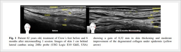 영등포리쥬란 눈가 주름 개선 효과는? 관련 이미지 2