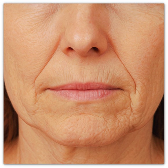 영등포역 필러 피부과 진료, 벨로테로 이마 팔자주름 효과, 그리고 중요한 것은? 관련 이미지 5