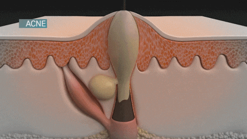영등포여드름피부과 진료, 약 먹기 싫고 치료 통증 두렵다면? 관련 이미지 7