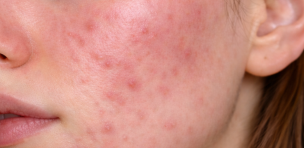 영등포 피부과 진료, 여드름 치료 어디로 갈지 고민이라면 관련 이미지 5