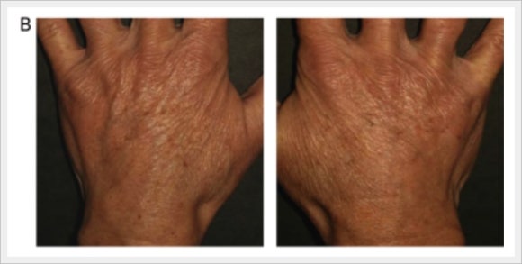 레디어스 손등 주름 시술 효과 어떨까? 관련 이미지 3