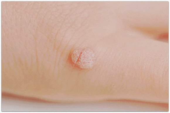 영등포사마귀, 피부 전염되는 이유와 관리 방법은? 관련 이미지 1