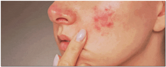 영등포여드름피부과 진료, 같은 자리에 자꾸 재발한다면? 관련 이미지 2