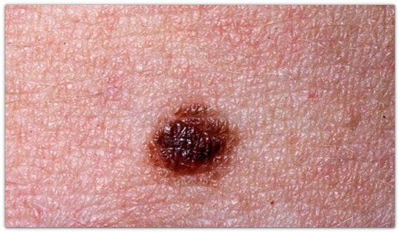 영등포점제거 깔끔하게 점빼기 가능할까? <재발 관련 내용 포함> 관련 이미지 4