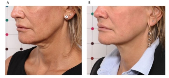 티타늄 온다 리프팅, 얼굴살이 고민일 때 효과적이다? 관련 이미지 7