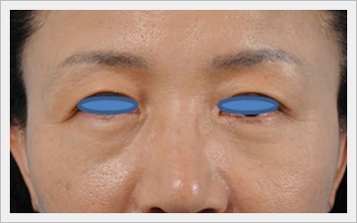 Does Eye Ulthera Work for Under-Eye Sagging? image 3
