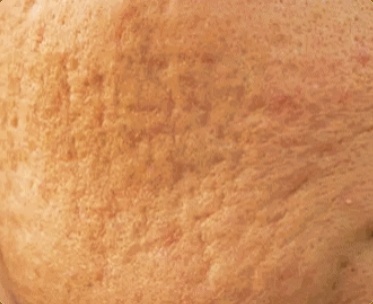 영등포여드름관리, 후기만 보지 말고 이것부터 확인해 보세요 관련 이미지 6