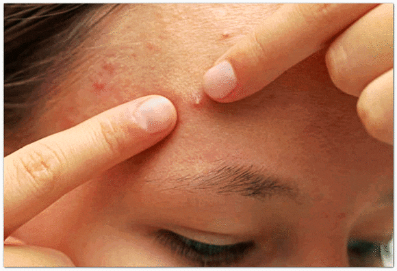 영등포역 근처 피부과 진료, 재발하는 여드름은 어떻게 관리해야 할까? 관련 이미지 4